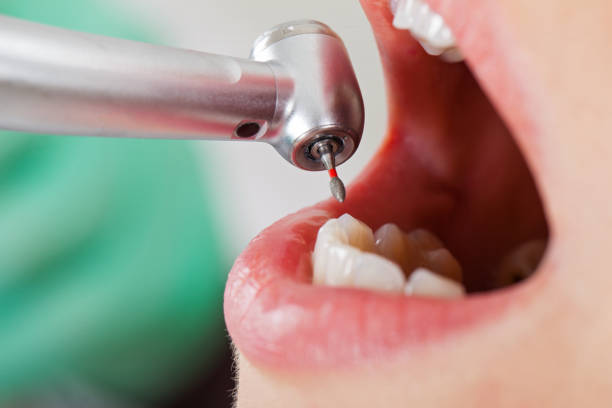 Best Emergency Tooth Extraction in Porters Neck, NC